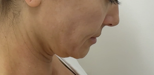 bg-01-after-brazilian