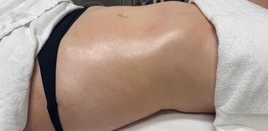 bg-01-bodyldrainage-after-brazilian bg-01-bodyldrainage-after-brazilian