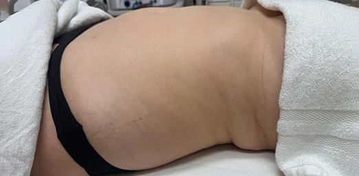 bg-01-bodyldrainage-before-brazilian bg-01-bodyldrainage-before-brazilian