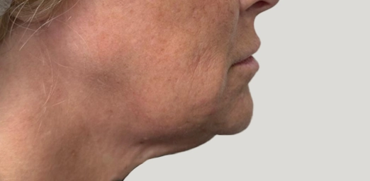 bg-01-facecyro-after-brazilian