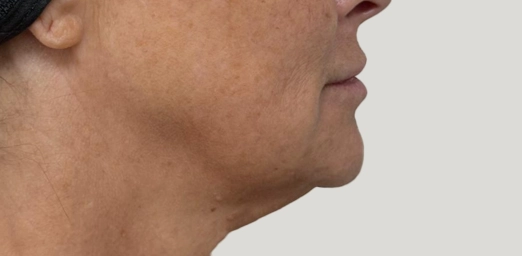 bg-01-facecyro-before-brazilian