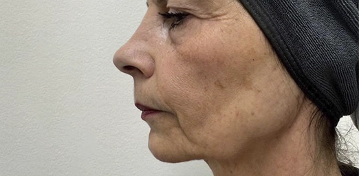 bg-02-after-brazilian