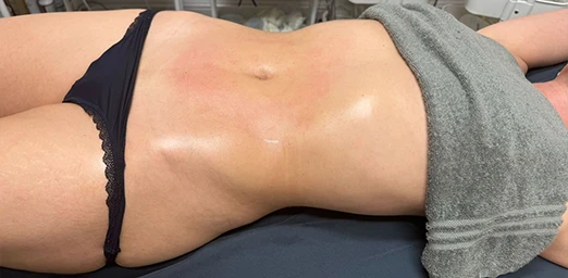 bg-02-bodyldrainage-after-brazilian bg-02-bodyldrainage-after-brazilian