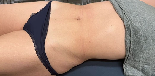 bg-02-bodyldrainage-before-brazilian bg-02-bodyldrainage-before-brazilian