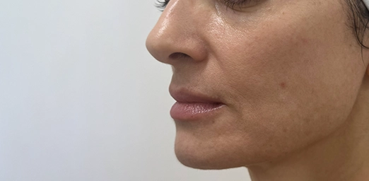 bg-03-after-brazilian