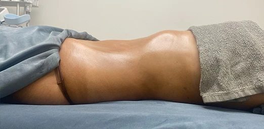 bg-03-bodyldrainage-after-brazilian bg-03-bodyldrainage-after-brazilian