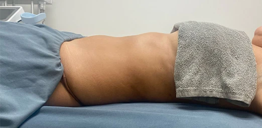 bg-03-bodyldrainage-before-brazilian bg-03-bodyldrainage-before-brazilian