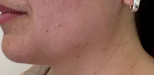 bg-03-facecyro-after-brazilian