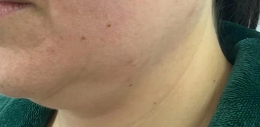 bg-03-facecyro-before-brazilian