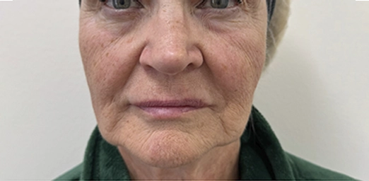 bg-04-after-brazilian