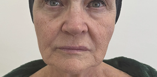 bg-04-before-brazilian