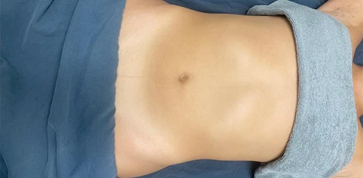 bg-04-bodyldrainage-before-brazilian